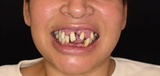 Yarely before full-mouth dental implant treatment at Golpa NexGen Smiles
